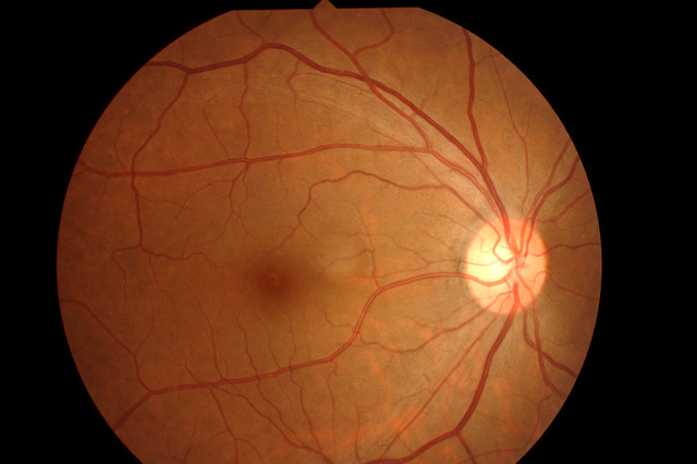 私の右目の眼底写真。はりめぐっているのは血管。白く光る小さな丸い部分が視神経のあるところ。この形や色に異常がないかを確認する。