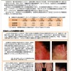 「消費者安全法第23条第１項の規定に基づく事故等原因調査報告書　毛染めによる皮膚障害」【概要】